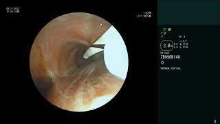 Endobronchial Lipoma  Bronchoscopic removal  Rigid Bronchoscopy  Snaring  Cryoextraction [upl. by Roman727]