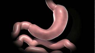 Laparoscopic Sleeve Gastrectomy Animation [upl. by Akinirt]