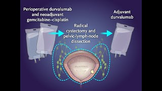 Perioperative Durvalumab in Bladder Cancer  NEJM [upl. by Neeroc186]