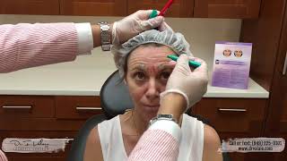 Full Face Botox Consultation and Injection by Dr Valaie MD [upl. by Niwroc327]