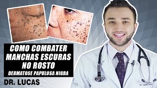 Como combater manchas escuras no rosto DERMATOSE PAPULOSA NIGRA DR LUCAS FUSTINONI [upl. by Eenaej]