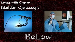 Bladder Cancer Cystoscopy [upl. by Etterb558]