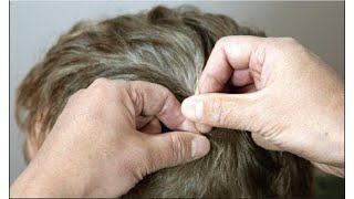 SCALP ACUPUNCTURE Needle Techniques [upl. by Gratianna]