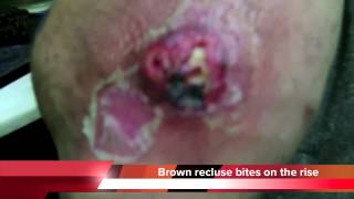 Brown recluse spider bites on the rise [upl. by Nairahcaz136]