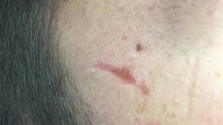 Acne scars subcision [upl. by Kwok]