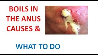 boils in the anus causes treatment home remedies and how to prevent it [upl. by Yssor]