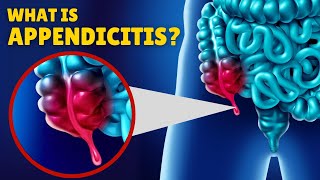 Appendicitis – Causes Signs and Symptoms Diagnosis amp Treatment [upl. by Llerral]