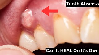 Can A Tooth Abscess HEAL On Its OWN  Find Out the Truth [upl. by Alexi866]