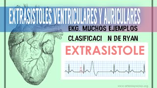 cardiología  EXTRASISTOLES VENTRICULARES Y AURICULARES CLASIFICACION DE RYAN medicina [upl. by Naryt]