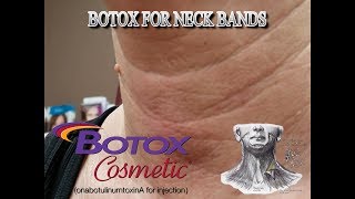 Botox Cosmetic in the Platysmal Bands AKA Neck Bands [upl. by Greenlee72]