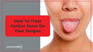 How to Treat Canker Sores on Your Tongue [upl. by Demah]