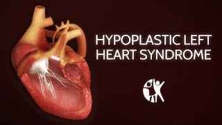 Hypoplastic left heart syndrome and norwood glenn fontan  NCLEXRN  Khan Academy [upl. by Dori]