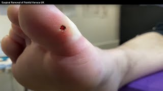 Surgical Removal of Painful Verruca UK [upl. by Aicxela713]