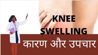 KNEE SWELLING HINDI  घुटने का दर्द कारण और उपचार  knee pain in hindi  CAUSES OF KNEE SWELLING [upl. by Dnomal]