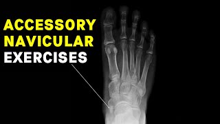 Accessory Navicular Syndrome Exercises by a Foot Specialist [upl. by Llenrad]