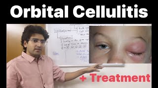 Orbital Cellulitis Pathology Clinical features and Treatment [upl. by Diane]