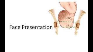 Obstetrics 471 Face Presentation ROP LMA MentoAnterior MentoPosterior Flanks not full No Moulding [upl. by Felicio]