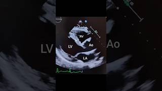 Parasternal Long Axis PLAX view with Color Flow Doppler echocardiography [upl. by Keg]