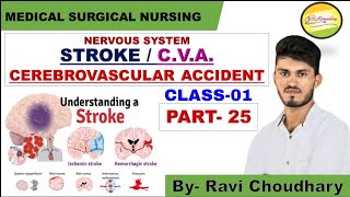 Cerebrovascular Accident StrokeBrain AttackNervous SystemPart25 by Ravi ChoudharyJINC JODHPUR [upl. by Tressa]