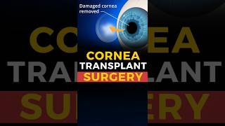 What Is Cornea Transplant Surgery [upl. by Hacissej]