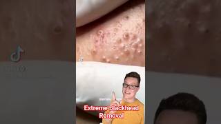 EXTREME BLACKHEAD REMOVAL  Blackhead Popping At Its Best shorts [upl. by Jezebel]