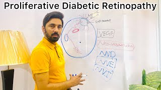 Proliferative Diabetic Retinopathy [upl. by Tyrus724]