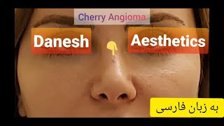 چطور می‌توان خال قرمز رنگ یا توده عروقی خوش خیم پوستی را ظرف کمتر از یک دقیقه برداشت؟ [upl. by Fonsie614]