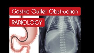 Gastric outlet Obstruction  Radiology [upl. by Aivax710]