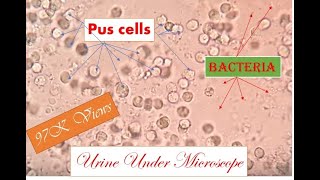 pus cells rbc bacteria in urine uti patient [upl. by Cirre]