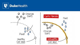 What is Cystic Fibrosis  Duke Health [upl. by Noeled]