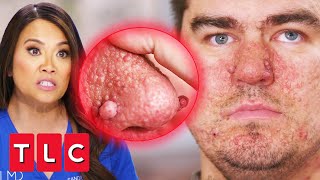 Dr Lee Treats An Autistic Patient With quotWartLike Bumpsquot On His Face  Dr Pimple Popper [upl. by Darnall]