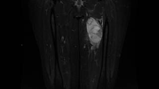 Myxofibrosarcoma grade 3 [upl. by Nuahsed]