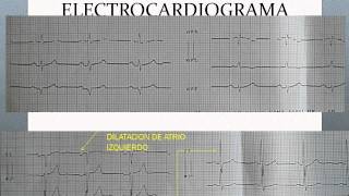 CARDIOPATIA HIPERTENSIVA Y DISFUNCION VENTRICULARwmv [upl. by Reffotsirk671]