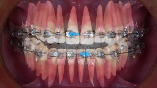 Clinical tip Midline Correction with Intermaxillary Elastics｜【Chris Chang Ortho】CC451 [upl. by Yehc]