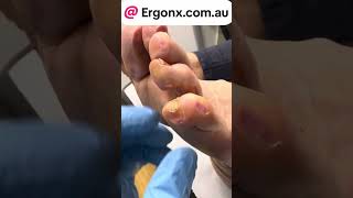 5th toe corn and callus removal by podiatrist satisfyjng to watch but very painfulhave [upl. by Senn44]