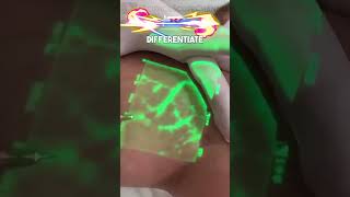 VeinViewer Visualizing Vein Location [upl. by Jobie]