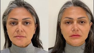 Antes e depois harmonização facial [upl. by Ahsaele]