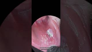 A new way to treat canker sores aphthous ulcers dentalhygiene dentalpain cankersores [upl. by Heintz707]