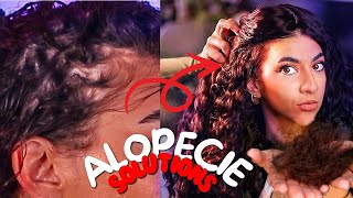 ALOPECIE LES SOLUTIONS NATURELLES [upl. by Ballard932]