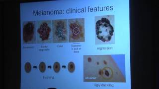 Early Detection of Melanoma [upl. by Strickman]