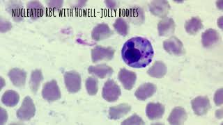 Metarubricyte with punctuate basophilic stippling [upl. by Adam]