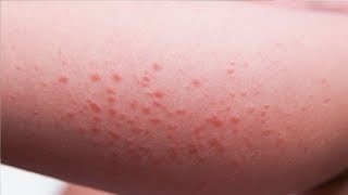 how to get rid of a skin rashes that itch [upl. by Renata]