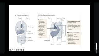 Cirugía Pediátrica  Hernia Diafragmática Congénita 11 [upl. by Desdee]