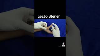 Lesão de Stener  Ruptura do Ligamento Colateral Ulnar [upl. by Asseral]