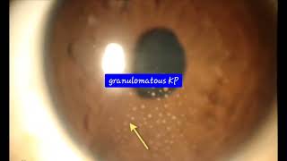 CorneaKeratic precipitatesGranulomatous Keratic precipitates KPOphthalmologyCornea [upl. by Immak152]