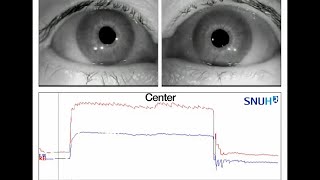 Bilateral Internuclear Ophthalmoplegia Observed in Anti–GQ1b Antibody Syndrome [upl. by Seadon]