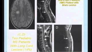 Neuromyelitis Optica and the concept of Autoimmune Aquaporin4 Channelopathy [upl. by Shari663]