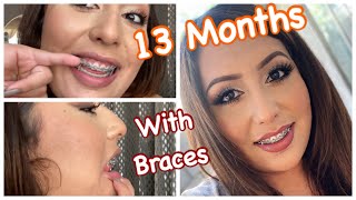 13 Months with BRACES  OverjetOverbite Correction Without Extractions  Damon Braces [upl. by Siward]