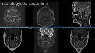 Osteonecrosis of the mandible [upl. by Arak801]