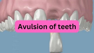 What is Avulsion of teeth [upl. by Siddon]